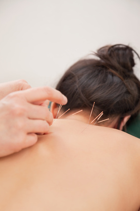 Acupuncture needles on back Acupuncture needles on back