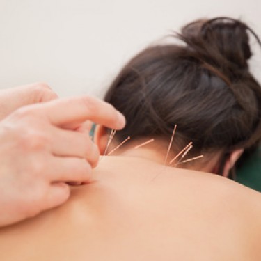 Acupuncture needles on back Acupuncture needles on back