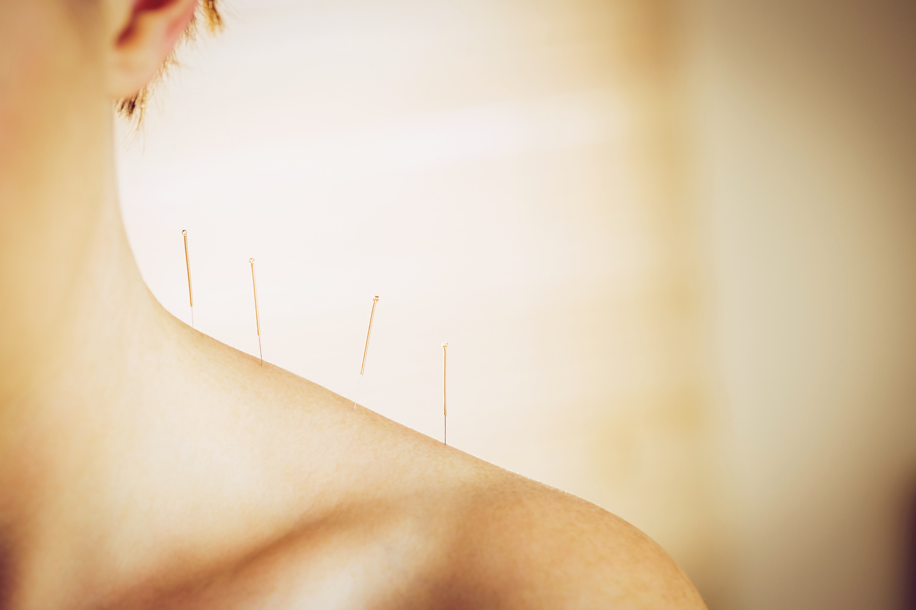 Acupuncture Wellness Headway Health